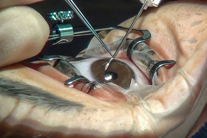 an image showing an eye being operated on.