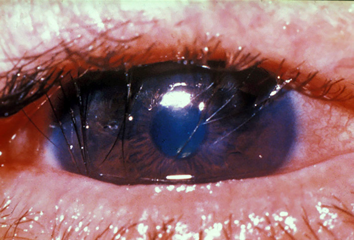 Close up image of an eye with eyelashes turning in towards the cornea