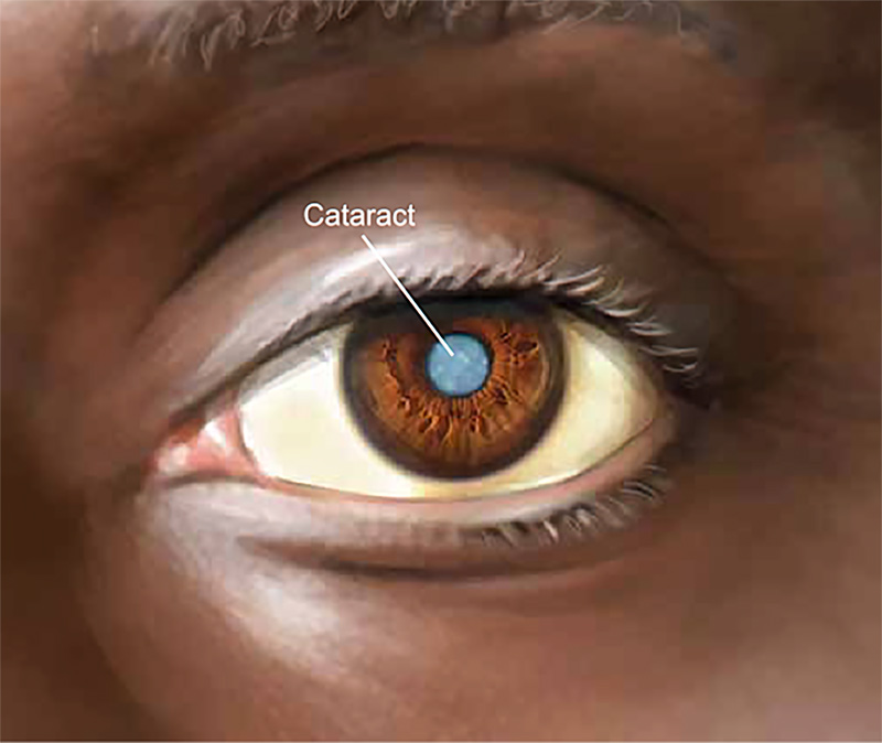 Drawing of eye to illustrate cataract
