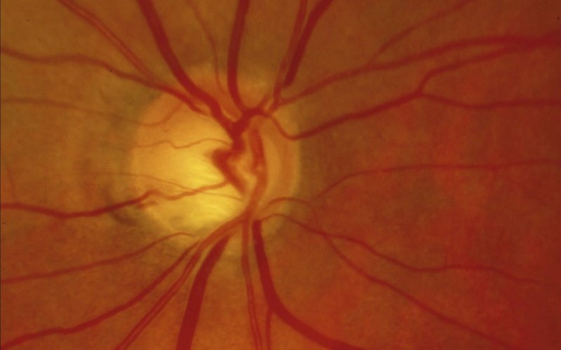 Glaucomatous optic neuropathy: splinter haemorrhages.© R Bourne