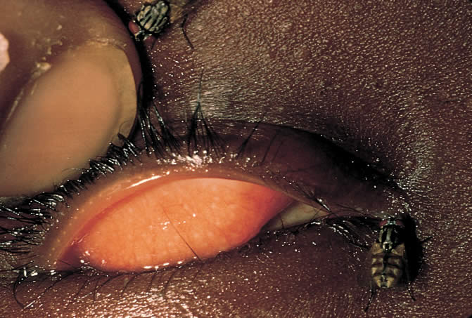 Community Eye Health Journal » Trachoma and fly control