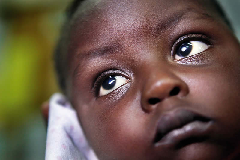 A young child with bilateral cataract. TANZANIA. © CCBRT/Dieter Telemans