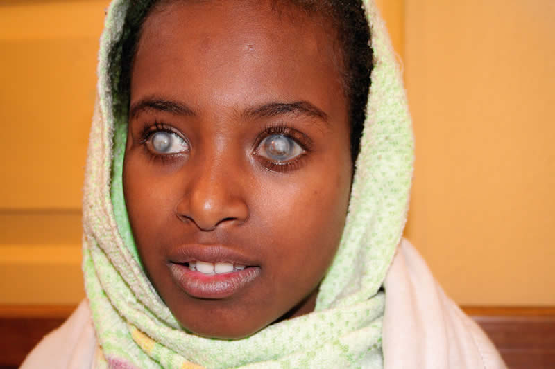 Corneal blindness often affects people at a young age, such as this twelve year old girl who is blind from vitamin A deficiency. She has had a penetrating corneal graft in her left eye; this has unfortunately failed. ETHIOPIA. © Lance Bellers