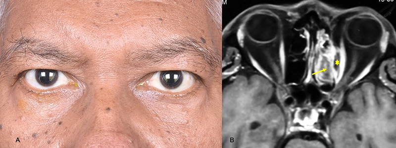 Two images side by side. On the left is a photograph of both eyes of a male patient. On the right, an MRI image