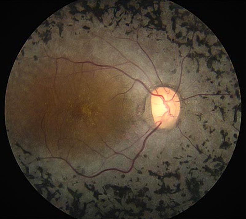 Воспаление сетчатки. Пигментный ретинит сетчатки. Тапеторетинальная абиотрофия сетчатки. Пигментный ретинит глазное дно. Пигментная абиотрофия сетчатки.