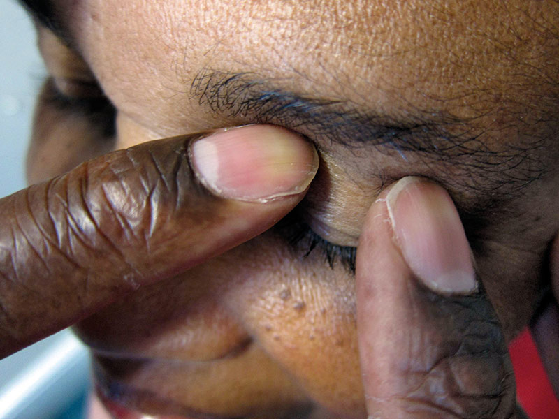applying gentle pressure to the eyelid using two fingers