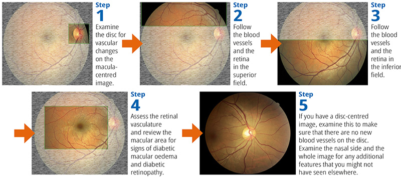 A aeries fo 5 retinal images illustrating a systematic approach to grading