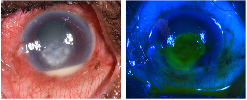 A close up image of an infected eye with and without a blue light