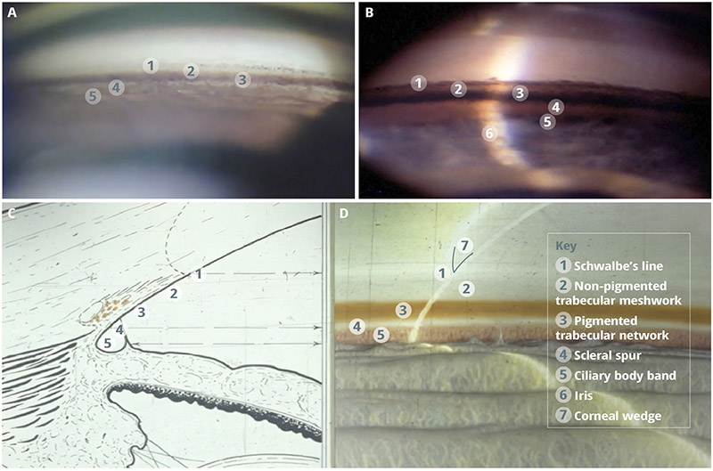 A series of four images (two drawings and two photographs) of the ocular structures seen when performing gonioscopy