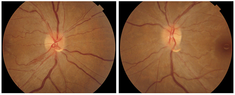 Two images of the retina/macula