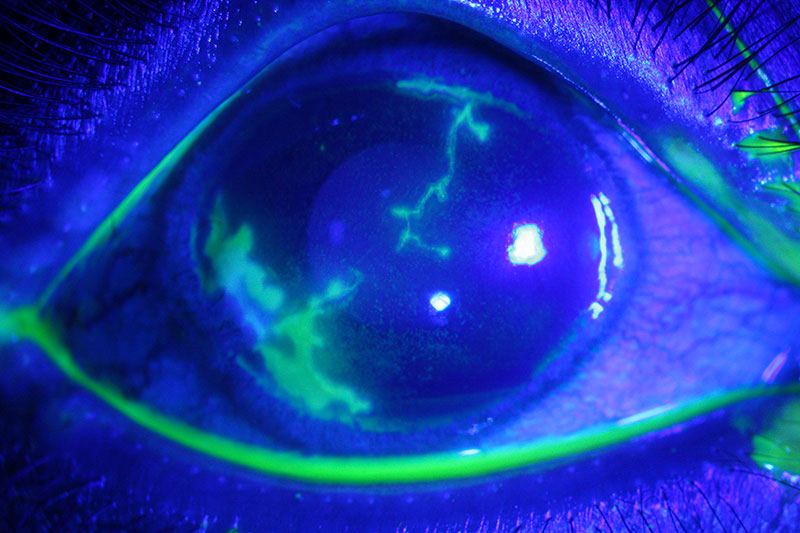 Close up image of a fluorescein stained eye with viral infection