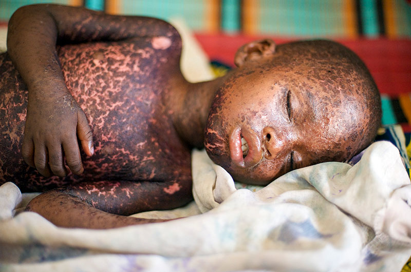 A child lying down, measles lesions all over torso and face