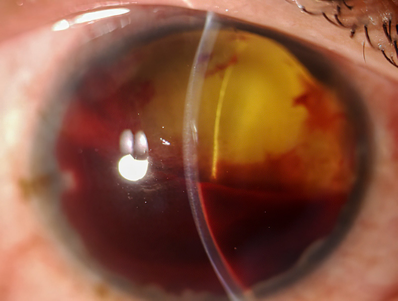 Close up image of the affected eye
