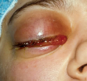 cellulitis under eye
