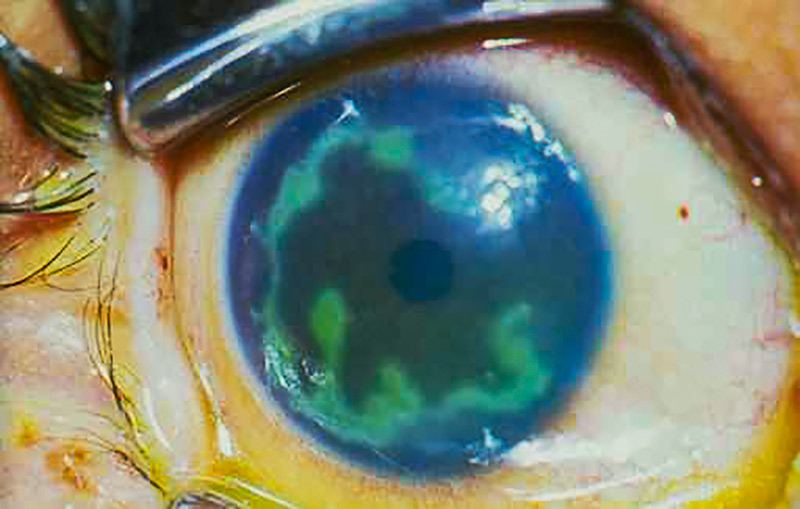 Close up image of the front of the eye - stained with fluorescein