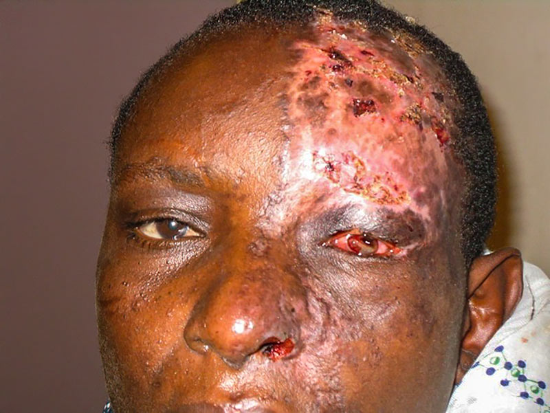 Close up of a person's face showing damage to the skin and corneal infection