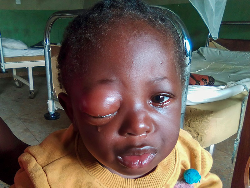 Image of a young child's head and shoulders. The right eye lid is swollen.