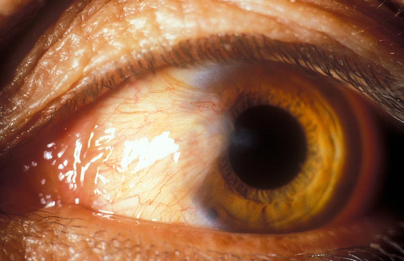 Growth of tissue on the white of the eye