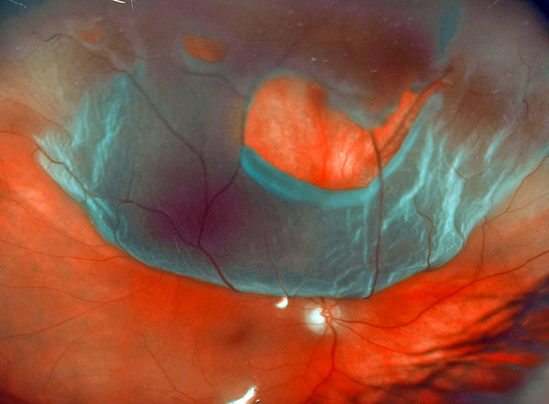 Image of detached retina