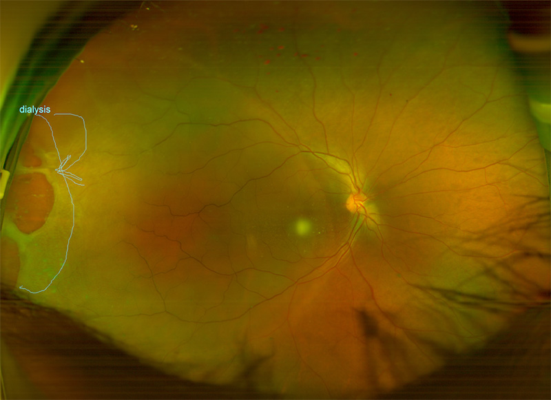 Close up retinal image