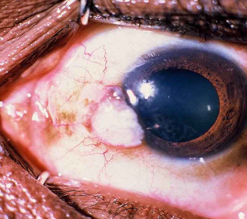 Close up image of the front of the eye