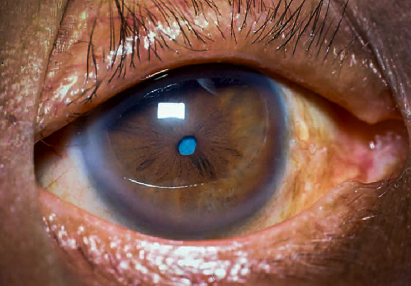 Close up image of eye showing small pupil