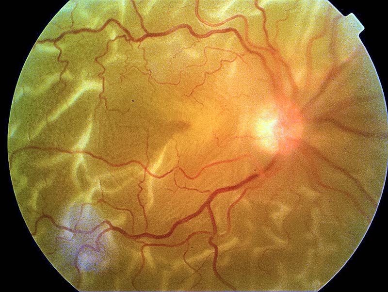Retinal image
