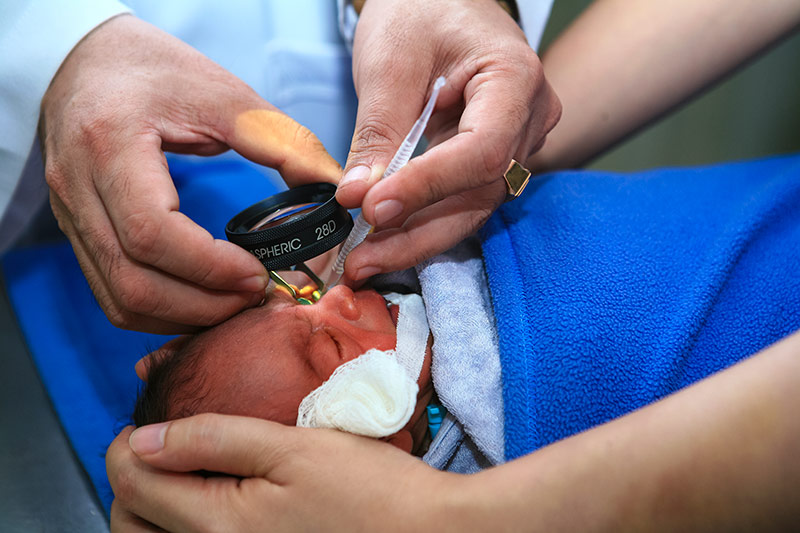 Preterm baby, with eyepatch removed, being examined with an indirect ophthalmoscope for ROP