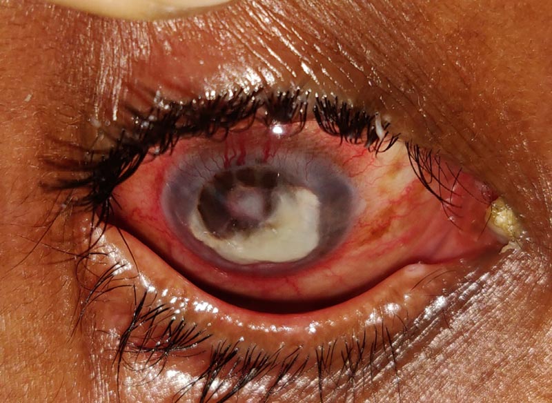 Close-up image of the affected eye