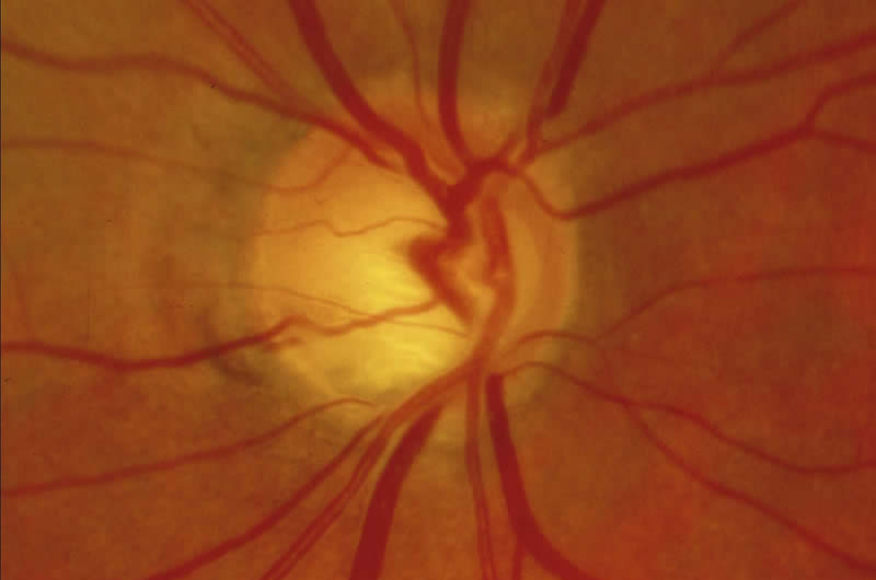 Neuropathie optique glaucomateuse : hémorragie en flammèche. R Bourne