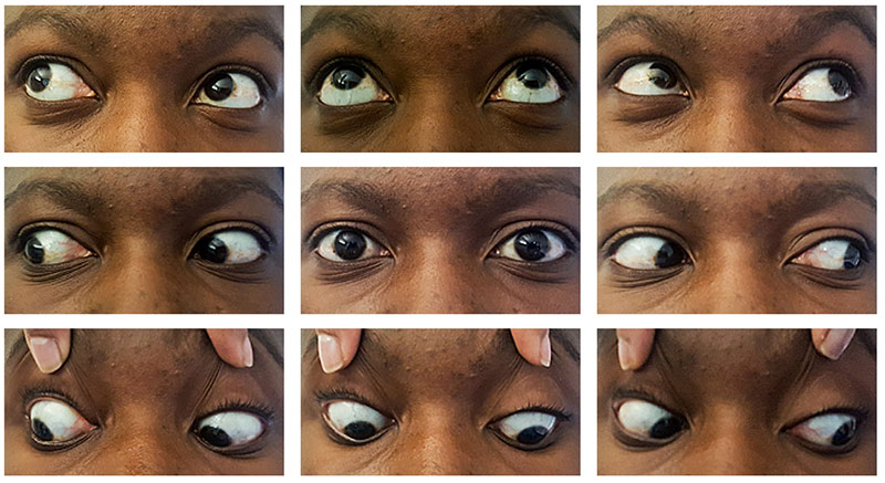 Community Eye Health Journal » How to check eye alignment and movement